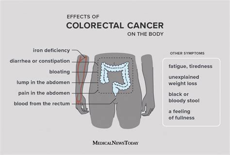 Colorectal Cancer Symptoms Treatment Risk Factors And