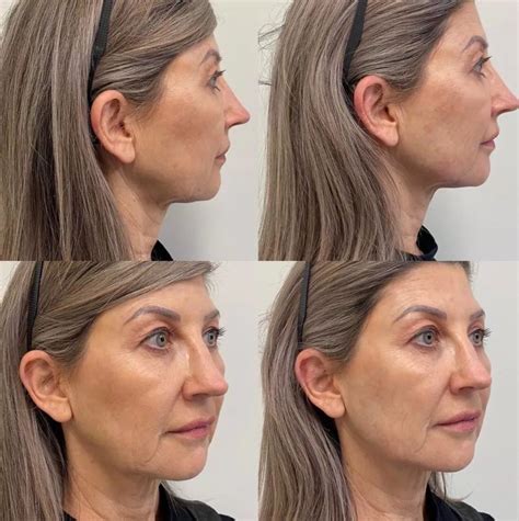 How To Get Rid Of Jowls Sagging Jowls Treatment Dr Doyle