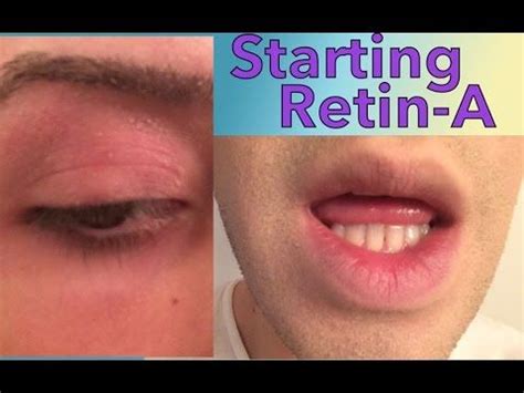 Then apply your retin a being careful to avoid the area that has vaseline on it. Starting Retin A Tretinoin for Acne and Anti-Aging ...