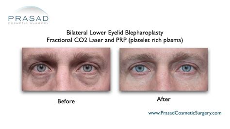 Under Eye Wrinkle Treatment Options Dr Prasad Blog