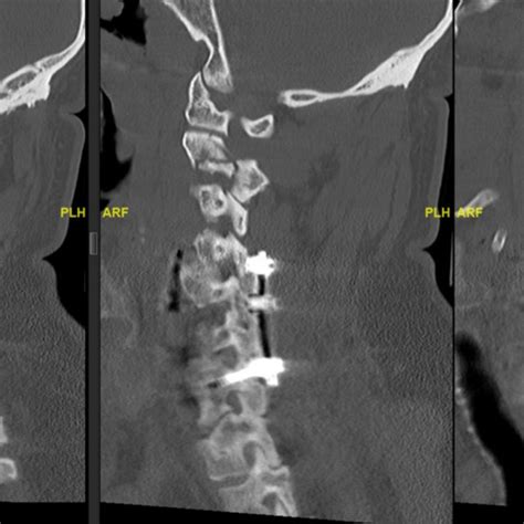 Sagittal Ct C Spine Demonstrating Unstable Atypical Hangmans Fracture