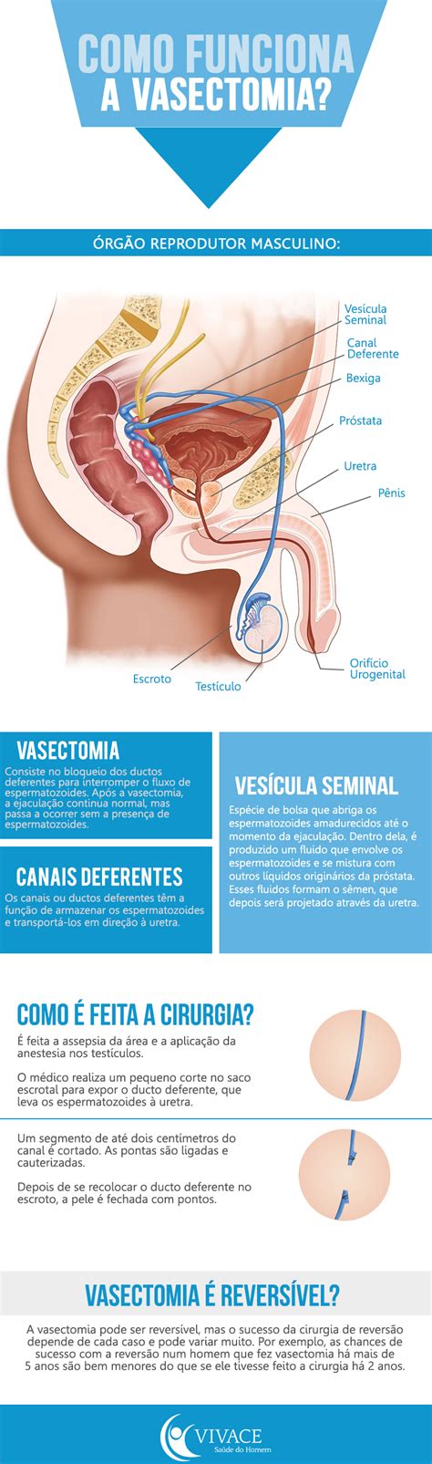 A vasectomia é um procedimento muito simples e eficaz. Infográfico: Como funciona a vasectomia? | Vivace Saúde do ...