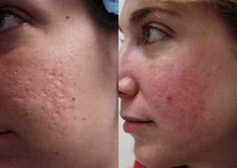 Home Remedies To Remove Deep Acne Scars Bellatory