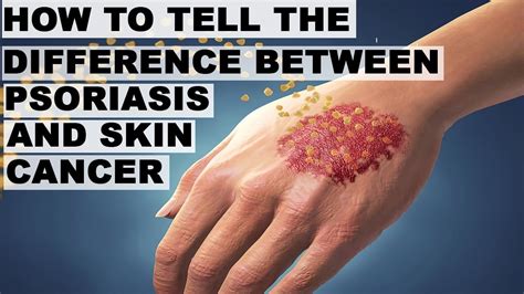 How To Tell The Difference Between Psoriasis And Skin Cancer Youtube