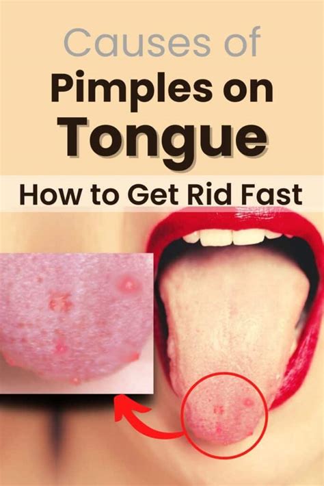 Pimple On Tongue Side Home Remedies Archives Medico Genius