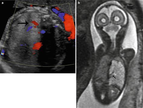 MRI Of The Fetal Chest Radiology Key