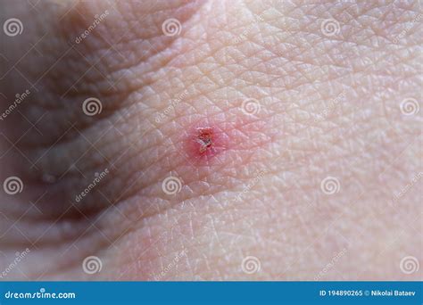 A Close Up Of A Dried Wound On Human Skin Stock Image Image Of