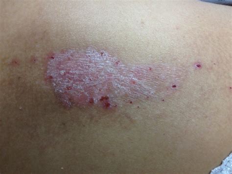 Is That Dry Skin Patch Plaque Psoriasis Lci Mag