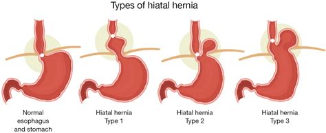 Which Hiatal Hernias Need To Be Fixed Large Small Or None Dunn