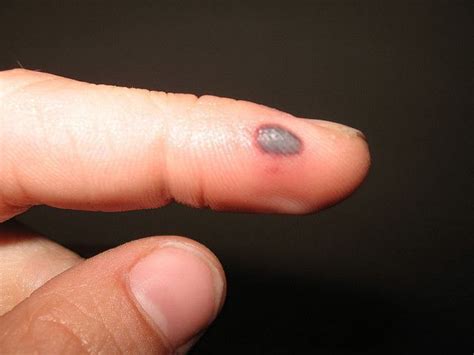 How To Get Rid Of Blood Blisters Blood Blister Blood Blister