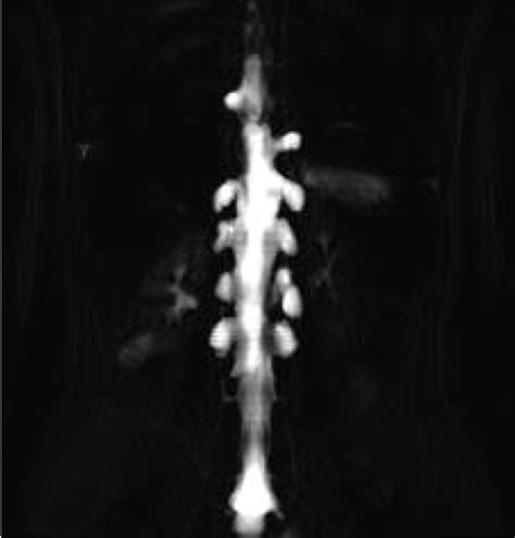 Mr Myelogram Haste Showing The Craniocaudal And Lateral Extent Of