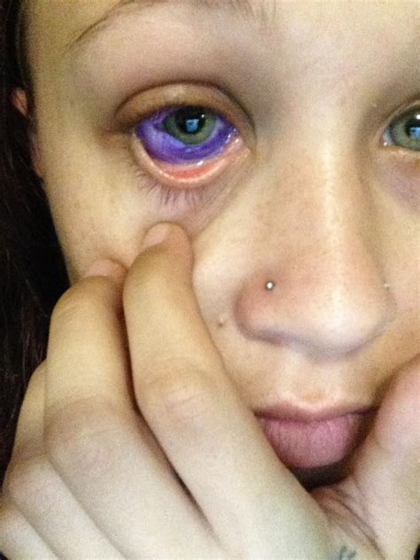 This Woman Got A Tattoo On Her Eyeball And It Went Horribly Wrong Herie