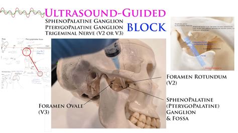 Ultrasound Guided Sphenopalatine Pterygopalatine Trigeminal Nerve