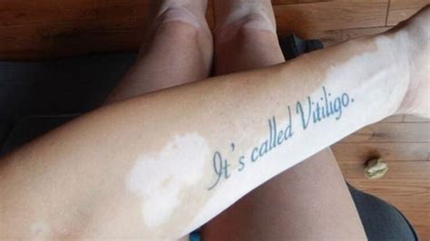 Woman Shares Photo Of Poignant Vitiligo Tattoo To Educate Those Who
