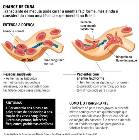 Médicos Pedem Aval Para Técnica Que Pode Curar Anemia Falciforme 18052013 Equilíbrio E