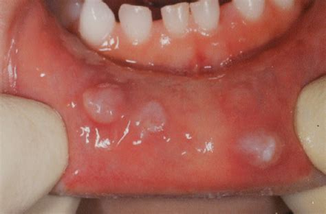 Multiple Mucoceles Of The Lower Lip A Case Report Abe 2019 Clinical Case Reports Wiley