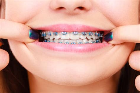 Do Braces Hurt When You Get Them Off And When Tightened The