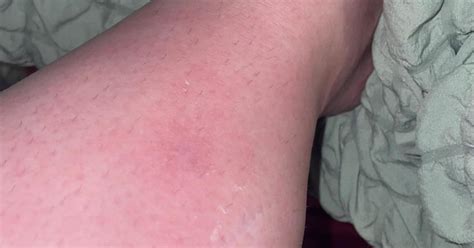 Red Blotches On Leg And Pain