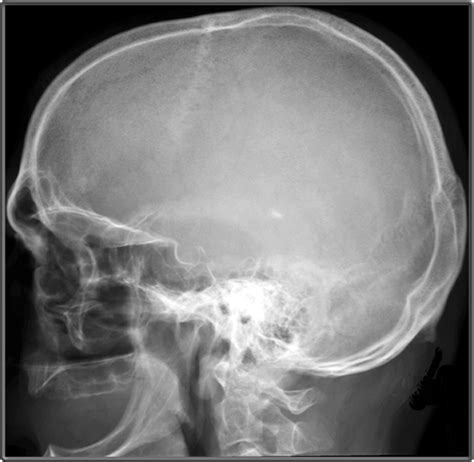 Clinical Anatomy Radiology Lateral Skull