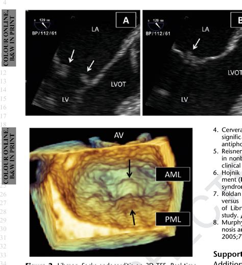Figure From Mitral Valve Libman Sacks Endocarditis Visualized By Real