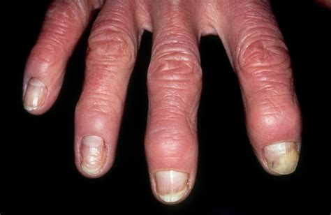 Psoriasis Of The Nails Images Tutor Suhu