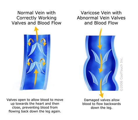 Minneapolis Varicose Veins Treatment Vein Surgery Clinic Spartz