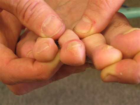 Dirty Runner Blisters Causes And Prevention