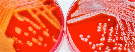 L'infezione da stafilococco aureo viene solitamente trasmessa attraverso il contatto fisico, nello specifico da mani contaminate. 3 modi per prevenire e trattare l'infezione da ...