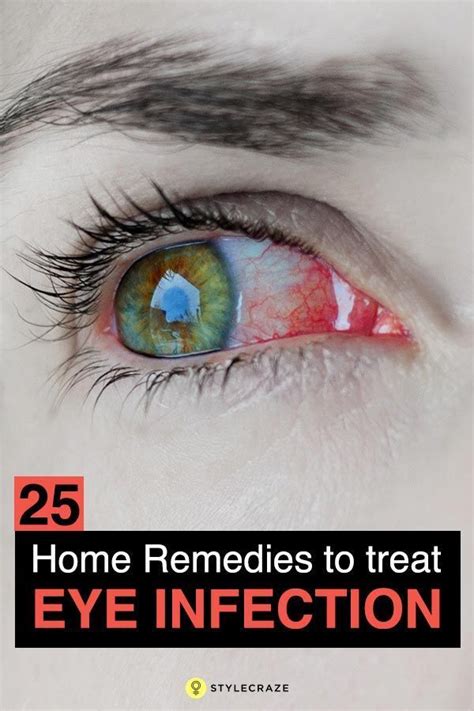 14 Effective Home Remedies To Get Rid Of Sore Eyes Eye Infections
