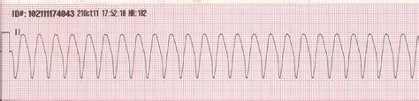 Pediatric Pulseless Ventricular Tachycardia Vt And Ventricular