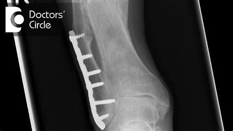 How Can One Manage Malunion Of Tibial Fracture After 6 Months Dr