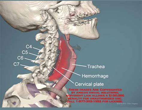 AMICUS Illustration Of Amicus Animation C C C C Trachea Hemorrhage Cervical Plate