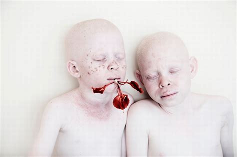 Murdered And Maimed For Their Body Parts Stunning Pictures Of The