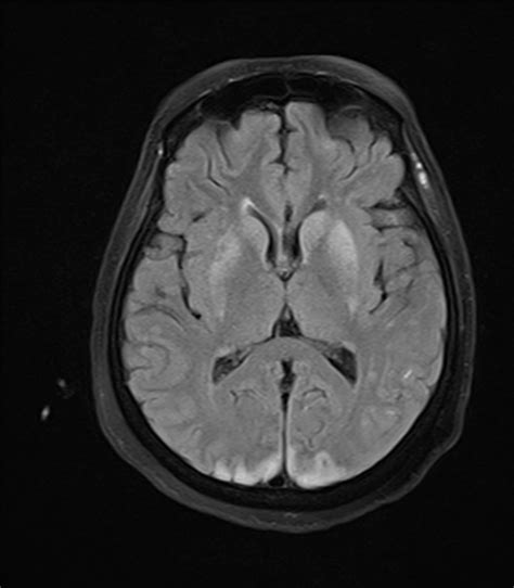 Ultimate Radiology Hypoxic Ischemic Brain Injury In A Post Cardiac