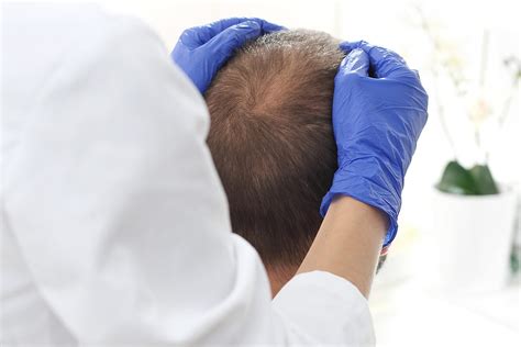 Alopecia Androgenetica Cause E Soluzioni Alla Perdita Dei Capelli