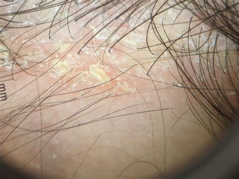 Mild Scalp Dermatitis