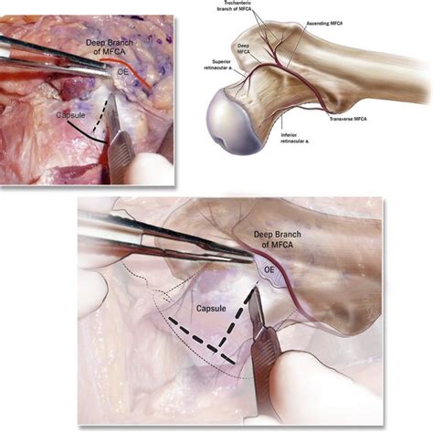 A T Shaped Capsulotomy Is Performed The Capsulotomy Begins Along The