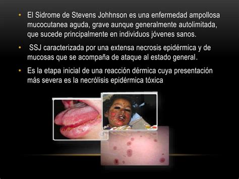 Síndrome Steven Johnson