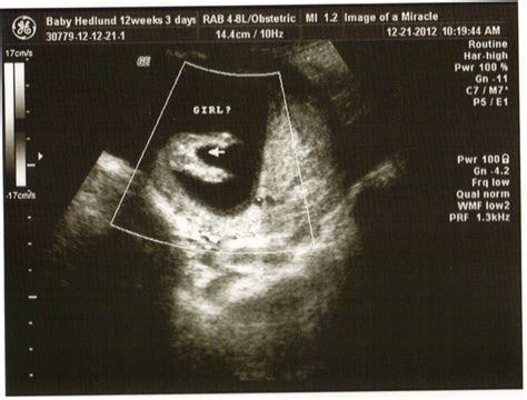 Boy Or Girl Ultrasound Tech Is Almost Positive Its A Girl Baby Is