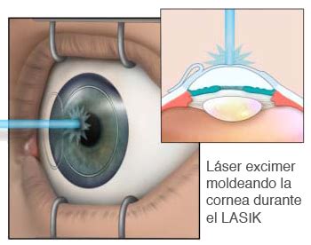 Dudas sobre LASIK Operación de Ojos