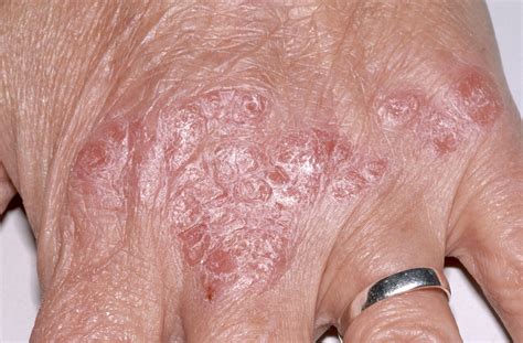 Addressing Cardiovascular Risks In Psoriasis Guidance For Clinical