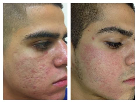 Laser Treatment For Scars Before And After Before And After