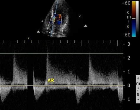 Aortic Regurgitation Trivial Doppler Tracing All About
