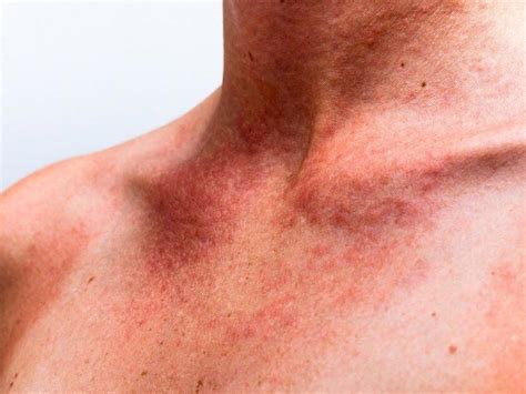 Sun Poisoning Can Be Referred To As A Skin Related Problem That Is