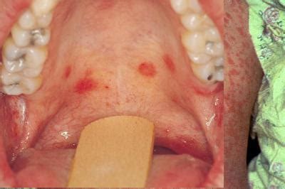 Tcm experts help to introduce the symptom of infectious mononucleosis, to create diagnosis and treatment plan for swollen tonsils, welcome to consult us. Childhood Infections - StudyBlue