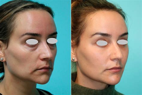 Tear Trough Under Eye Injections Before And After Photos Plastic