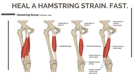 Hamstring Injury Treatment Hamstring Strain What Is It What Can I Do