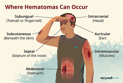 Hematoma Types Causes Treatment And More