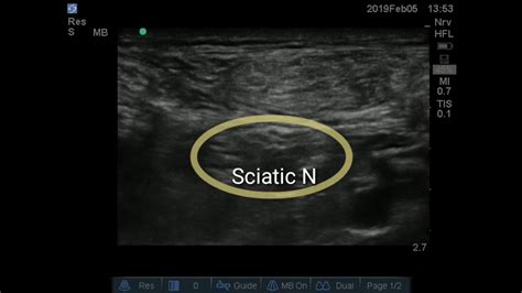 Ultrasound Guided Popliteal Approach To Sciatic Nerve Block Youtube
