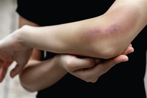 How To Cover A Bruise With Makeup That Will Actually Hide Your Black